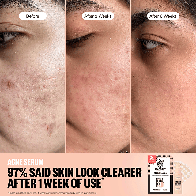 Acne Healing Dots Mega Value Set with Full-Size Acne Serum