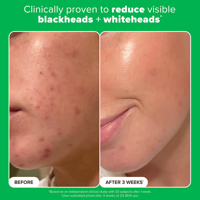 Complexion Clarity Duo with Salicylic Acid & Azelaic Acid