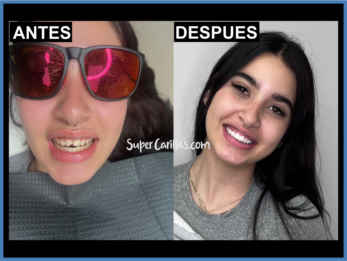 Carillas de porcelana en Miami y Orlando - Antes y después