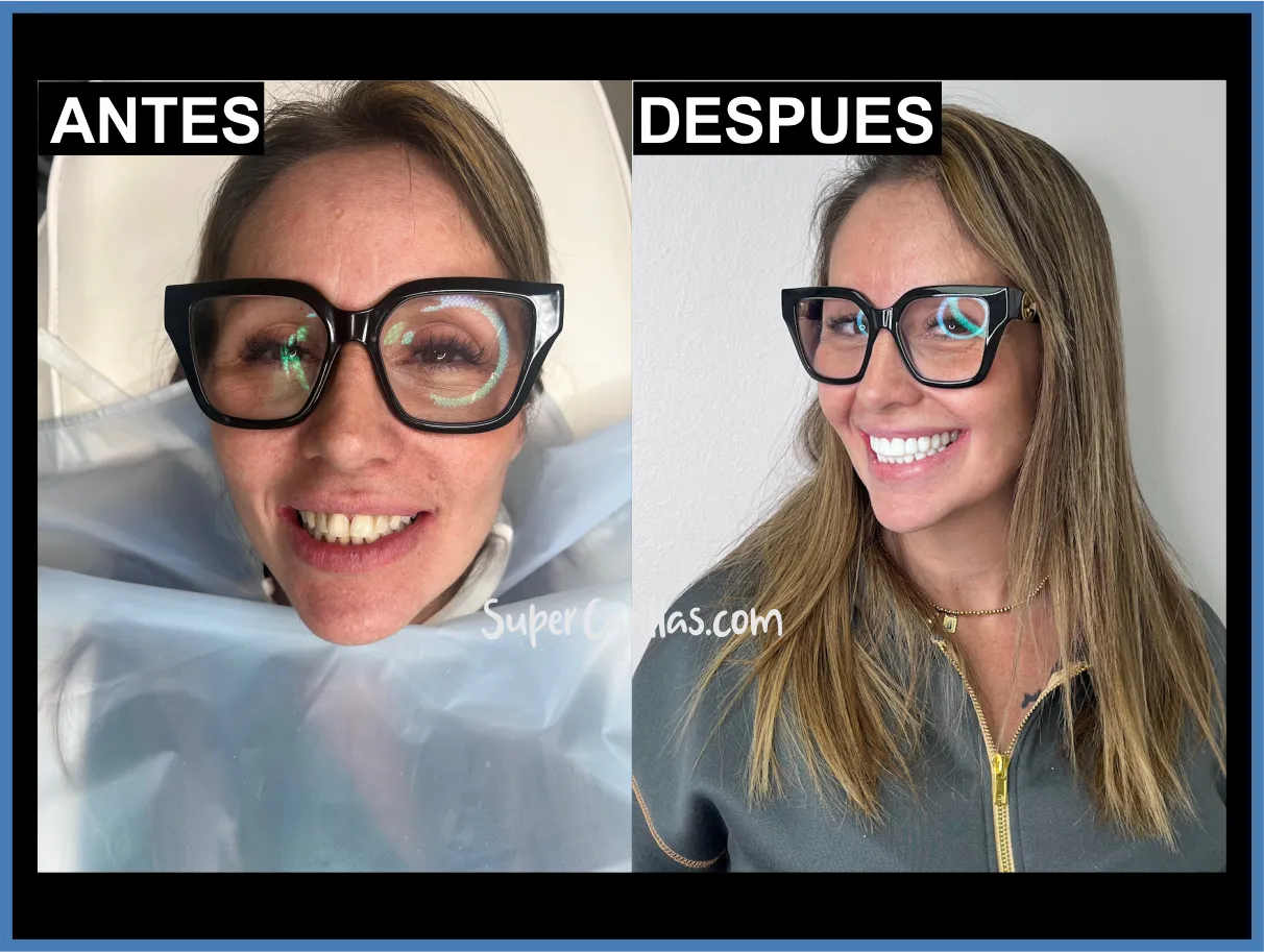 Carillas de resina en Orlando y Miami - Antes y después