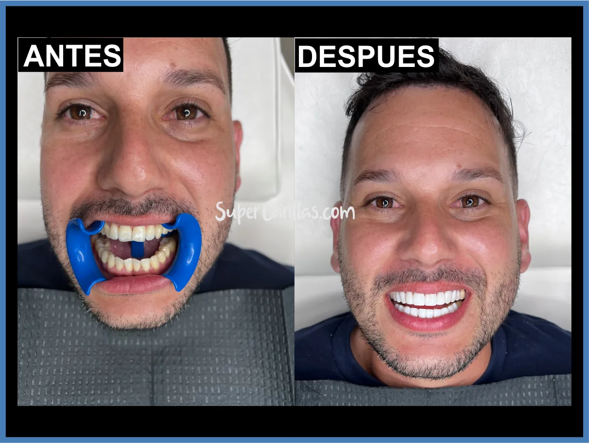 Carillas estéticas en Miami y Orlando - Antes y después