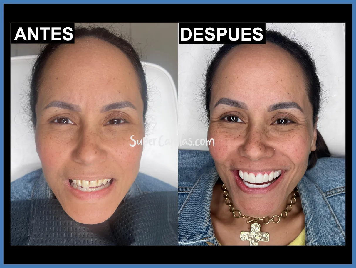 Cambio de sonrisa con carillas en Orlando y Miami - Antes y después