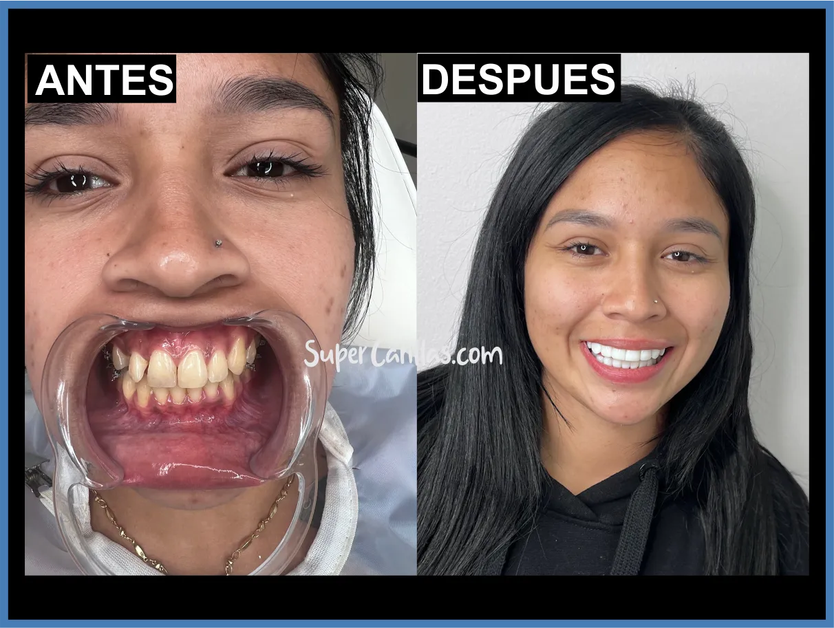 Coronas dentales en Miami y Orlando - Antes y después