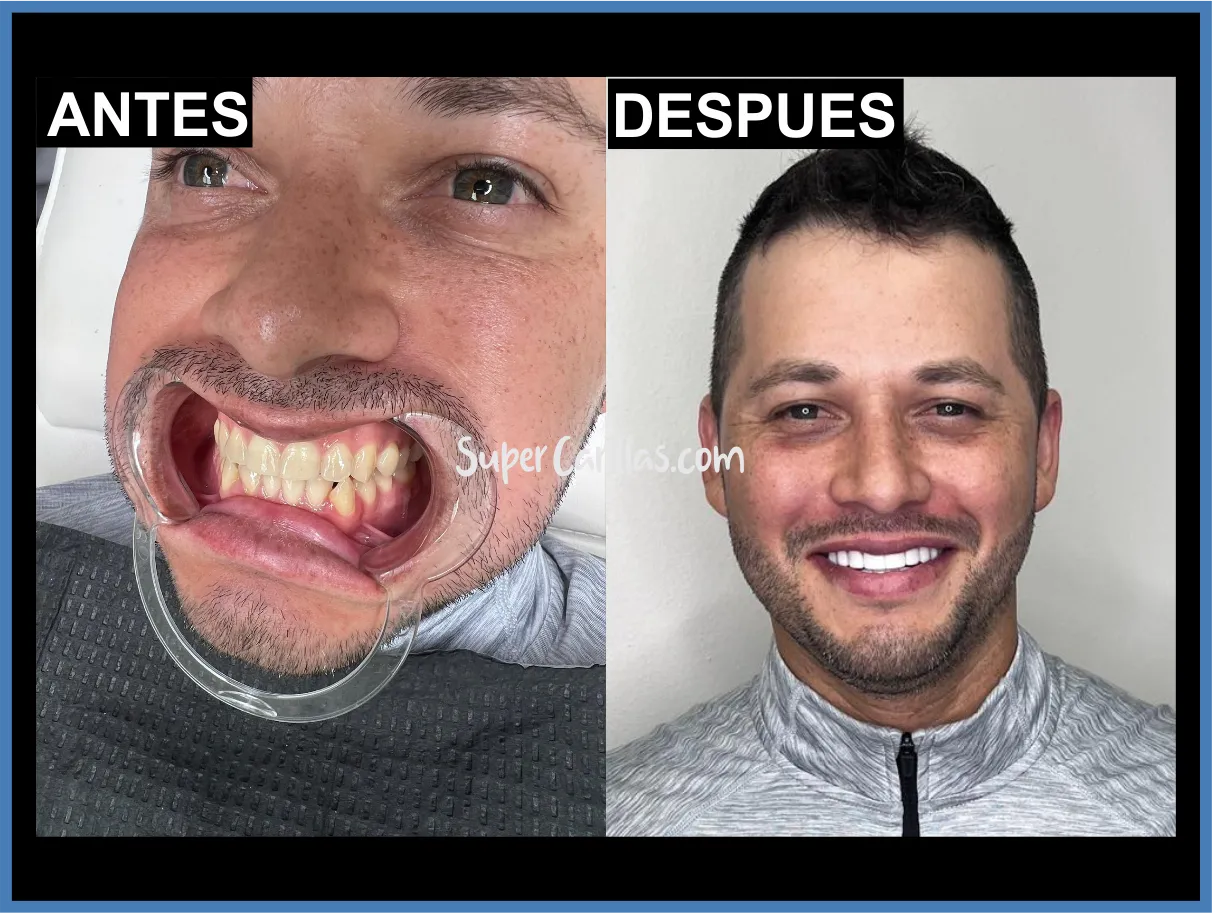 Correción dental con carillas en Orlando y Miami - Antes y después
