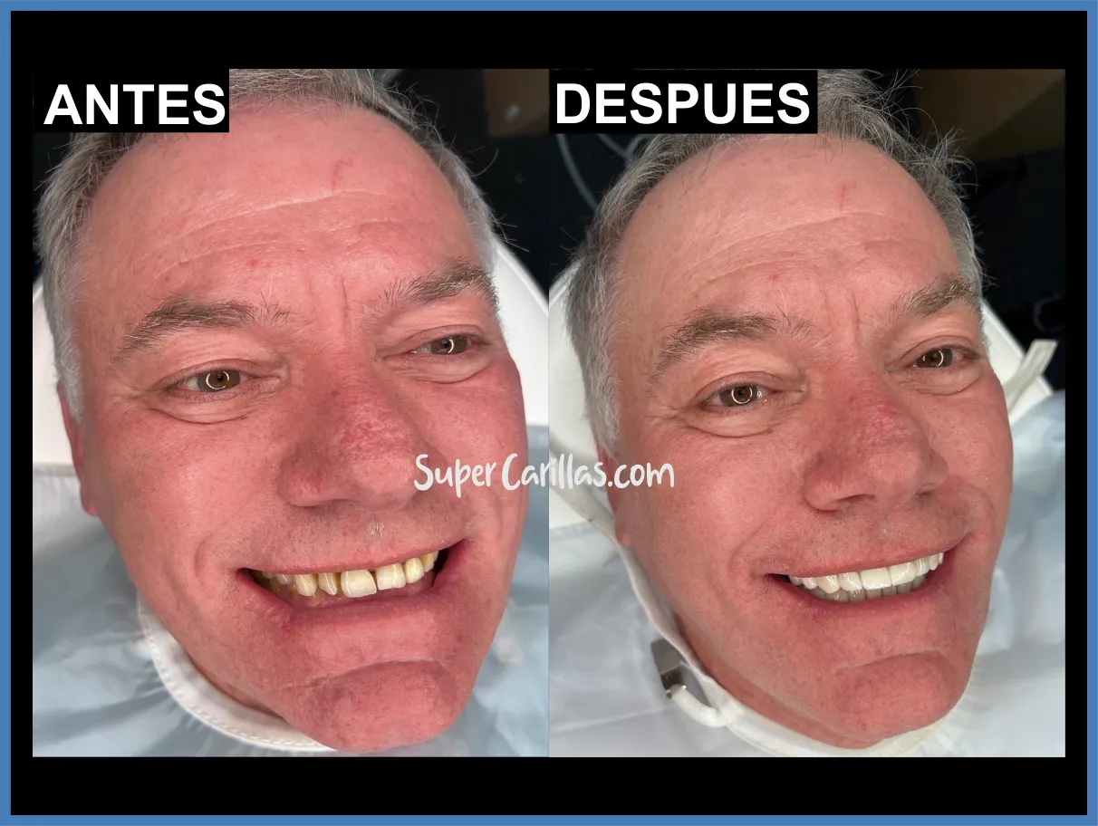 Resultados con carillas dentales en Miami y Orlando - Antes y después