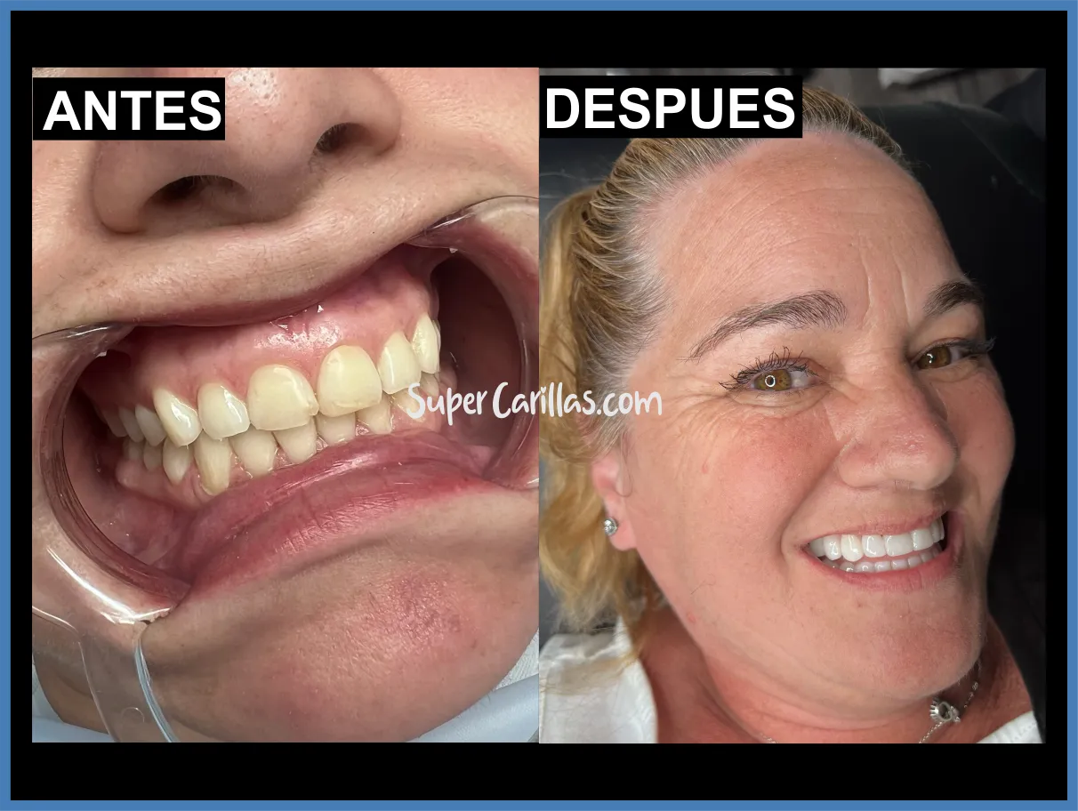 Sonrisa perfecta con carillas en Miami y Orlando - Antes y después