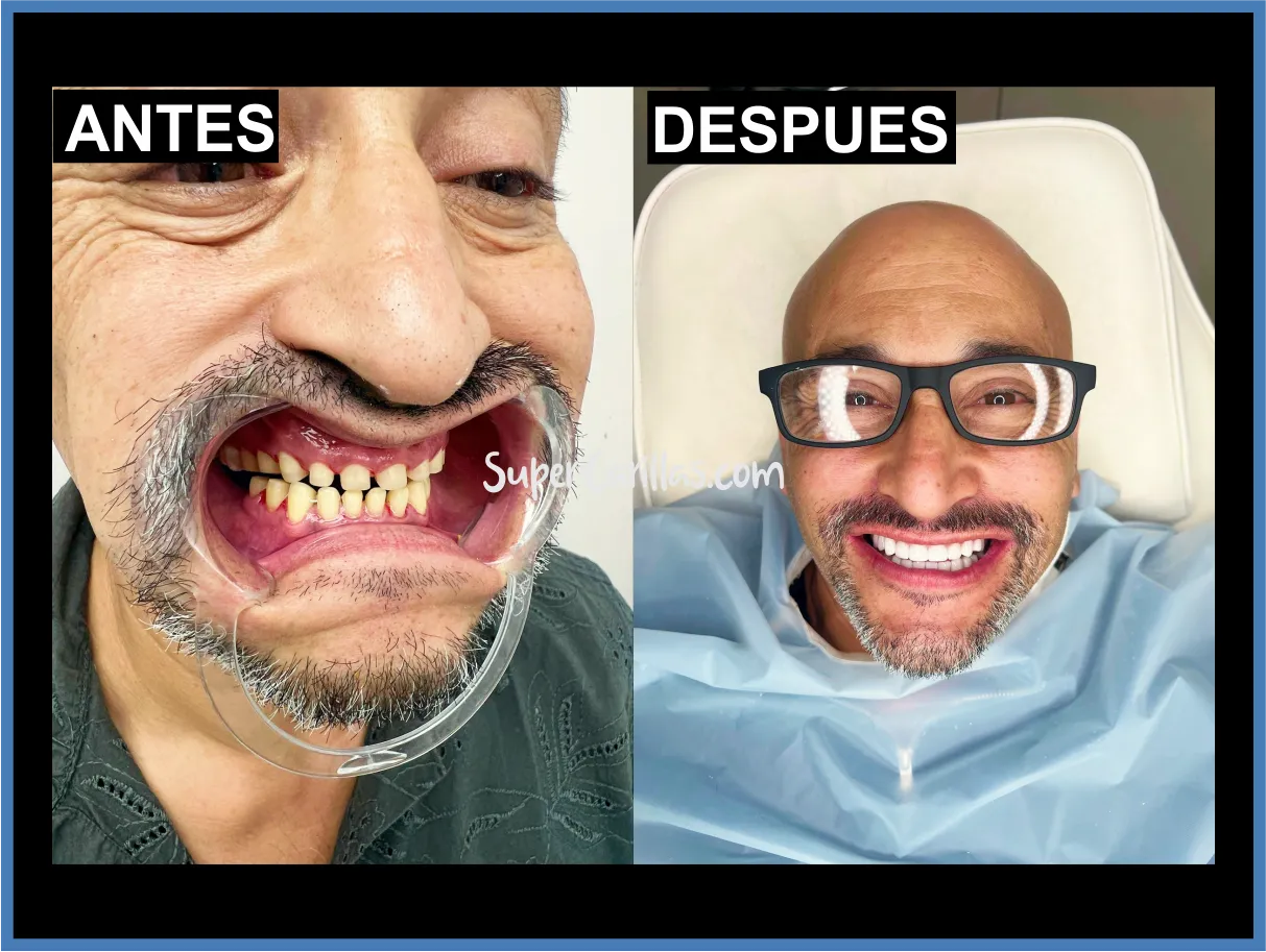 Sonrisa con carillas de resina en Miami y Orlando - Antes y después
