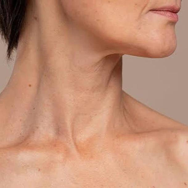 Rejuvenecimiento Intensivo Cuello: Morpheus8 + Sculptra 1 sesión + Dysport Nefertiti lift y bandas platismales