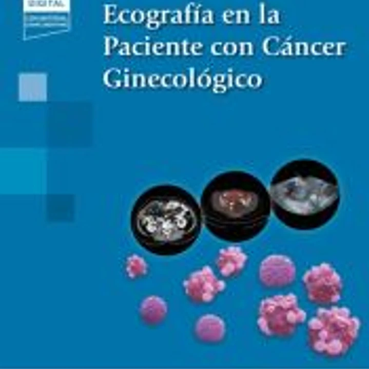 Ecografía en la Paciente con Cáncer Ginecológico (+ e-book) 1