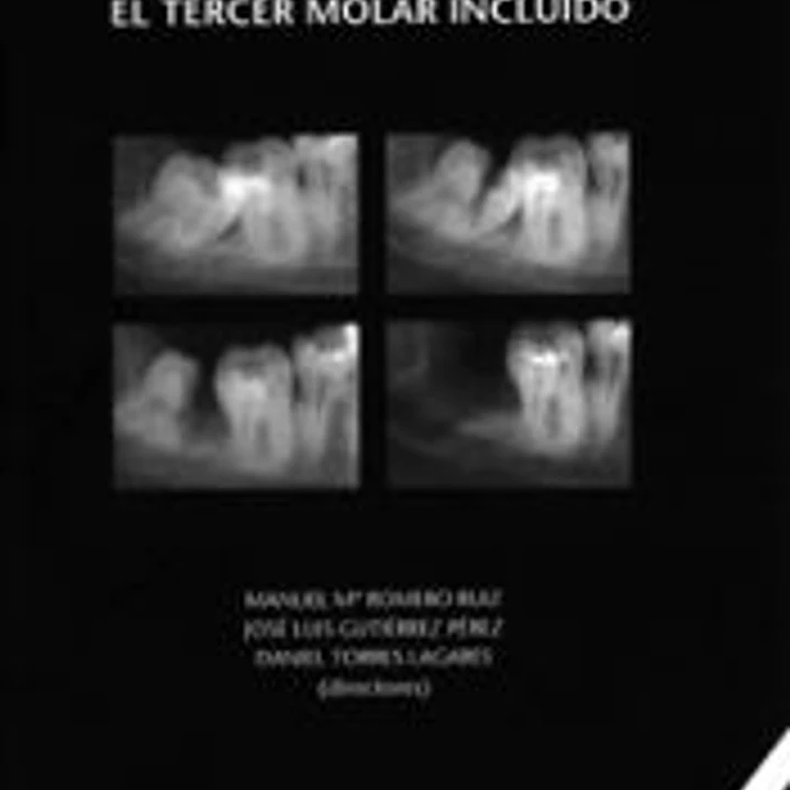 EL TERCER MOLAR INCLUIDO. 2ED 1