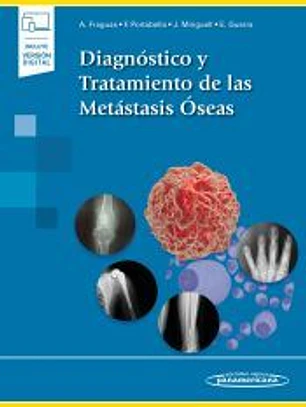 Diagnóstico y Tratamiento de las Metástasis Óseas (incluye versión digital)