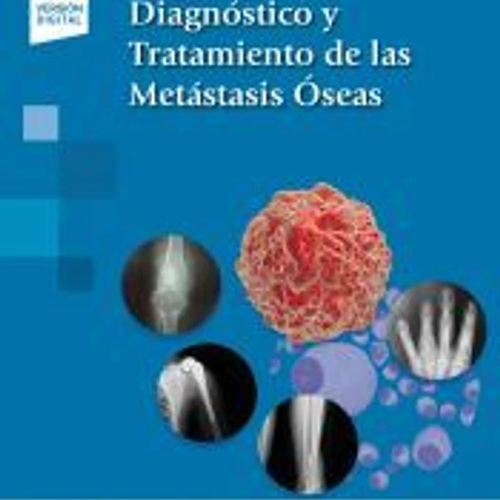 Diagnóstico y Tratamiento de las Metástasis Óseas (incluye versión digital) 1
