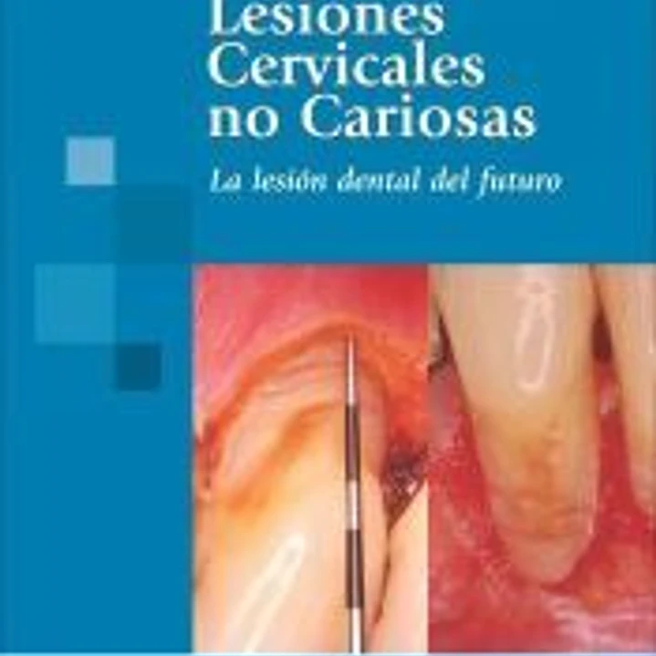 Lesiones Cervicales no Cariosas. La Lesión dental del futuro 1