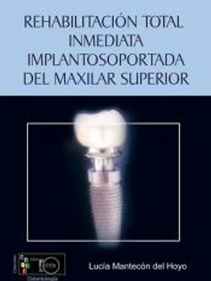 Rehabilitación total inmediata implantosoportada del maxilar superior: técnicas de carga inmediata