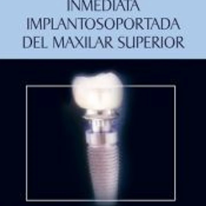 Rehabilitación total inmediata implantosoportada del maxilar superior: técnicas de carga inmediata 1