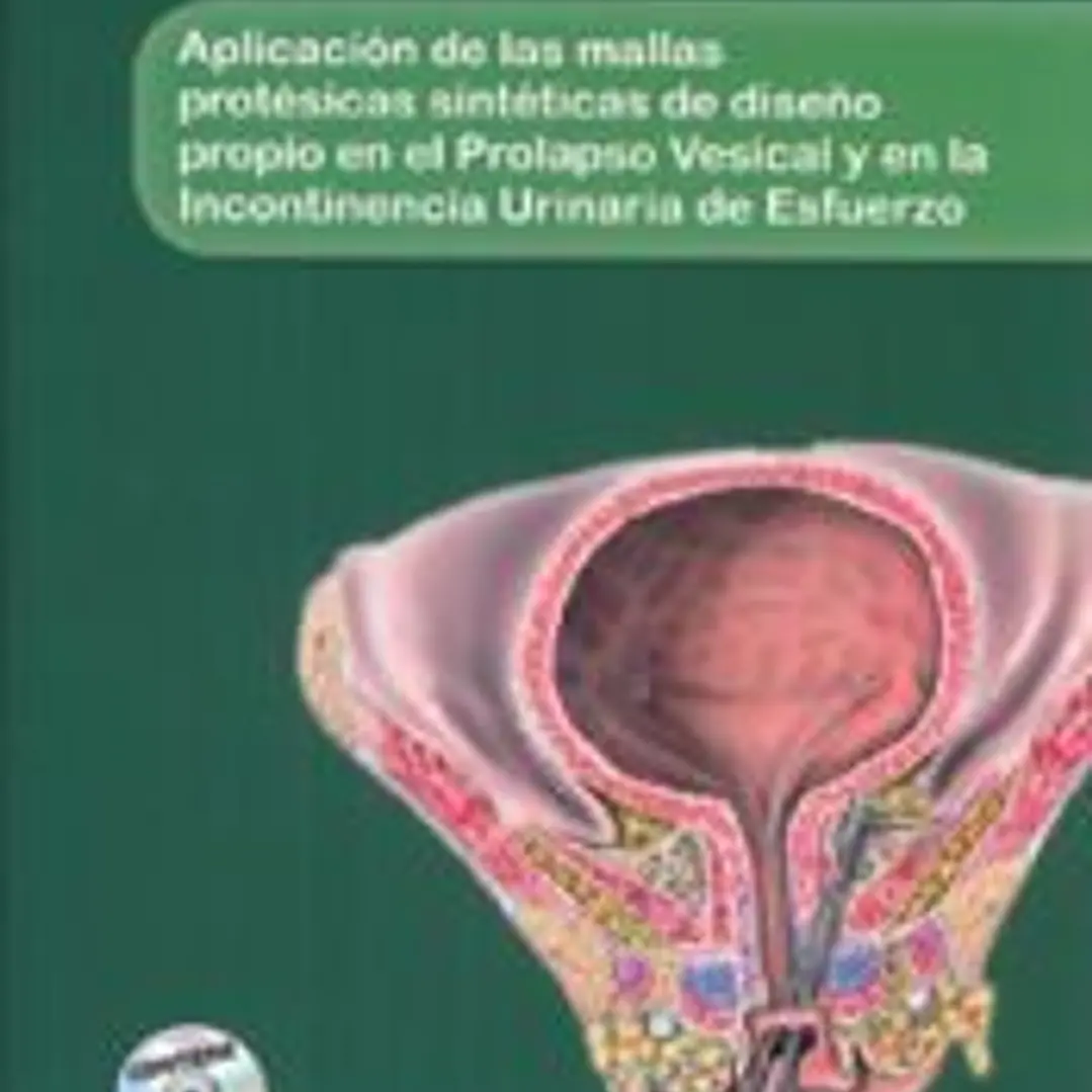 Aplicación de las mallas protésicas sintéticas de diseño propio en el prolapsi vesical y en la incotinencia urinaria de esfuerzo 1