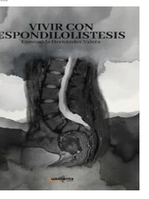 Vivir con espondilolistesis
