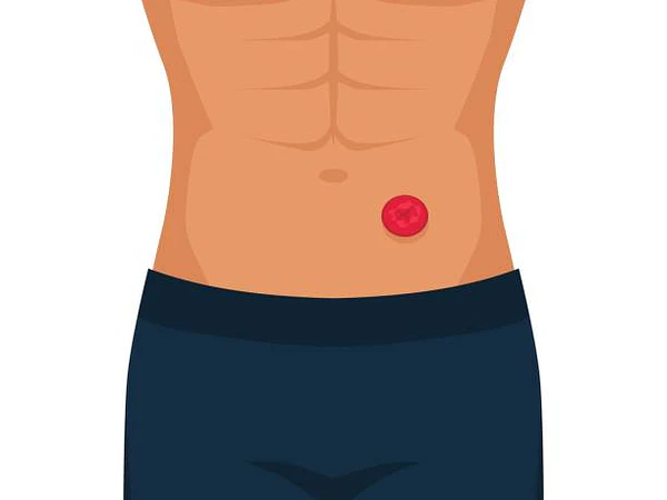 ¿Qué es un estoma? Una guía completa para entender las ostomías