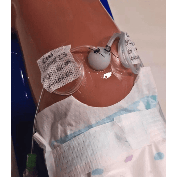 Simulador Colocación de catéter umbilical 2
