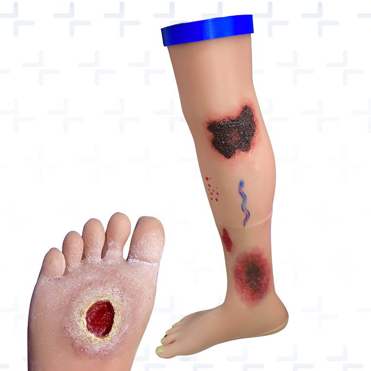 Pierna con diferentes estados de úlceras venosas 1