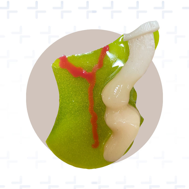 Plataforma laparoscopica para apendicectomia 2