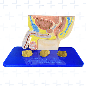 Modelo anatómico de próstata con nódulos palpables 
