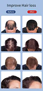 Terapia de Luz Roja Infrarroja 850nm para Cabello + Esencia de Menta | Cuidado Capilar InnovaTek - Miniatura 3