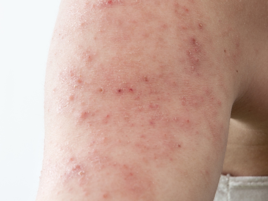 Dermatitis Atópica: Cuando eres más ganas de rascarte que persona