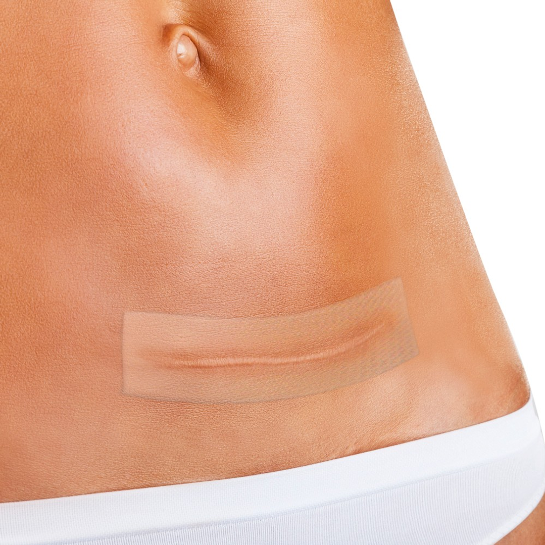 Parche de Silicona para Cicatrices 2