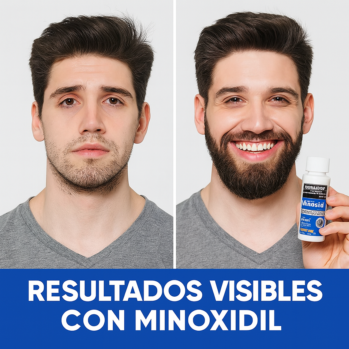 Minoxidil Kirkland + Dermarroller Crecimiento de Barba y Cabello tratamiento 1 Mes 60 ML 8