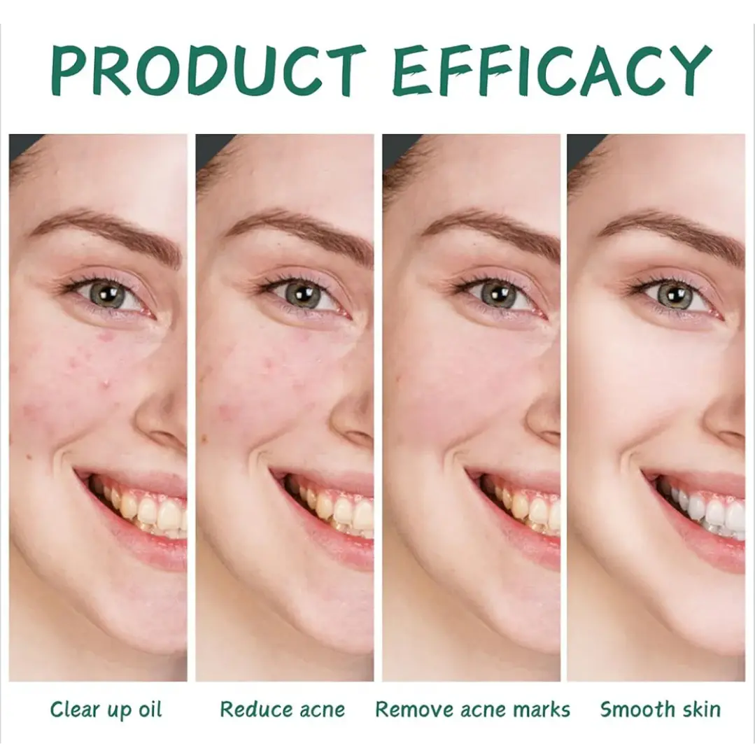 Kit Facial Anti Acné Bioaqua x 4 Productos 5