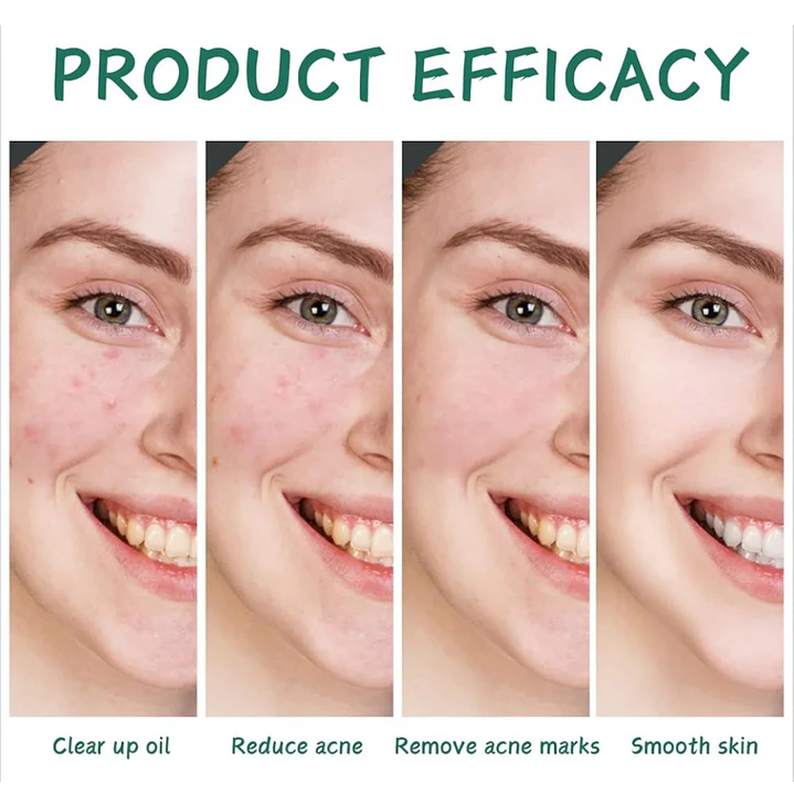 Kit Facial Anti Acné Bioaqua x 4 Productos 5