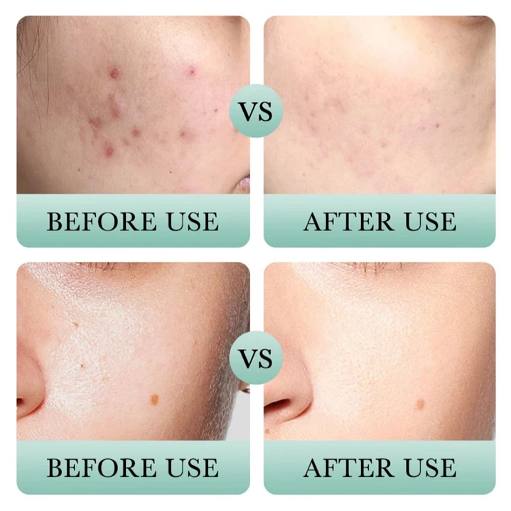 Kit Facial Anti Acné Bioaqua x 4 Productos 6