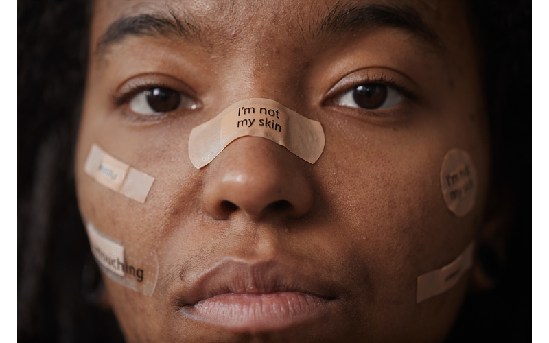 ¿Cómo cuidar nuestra salud mental cuando estamos luchando contra el acné?