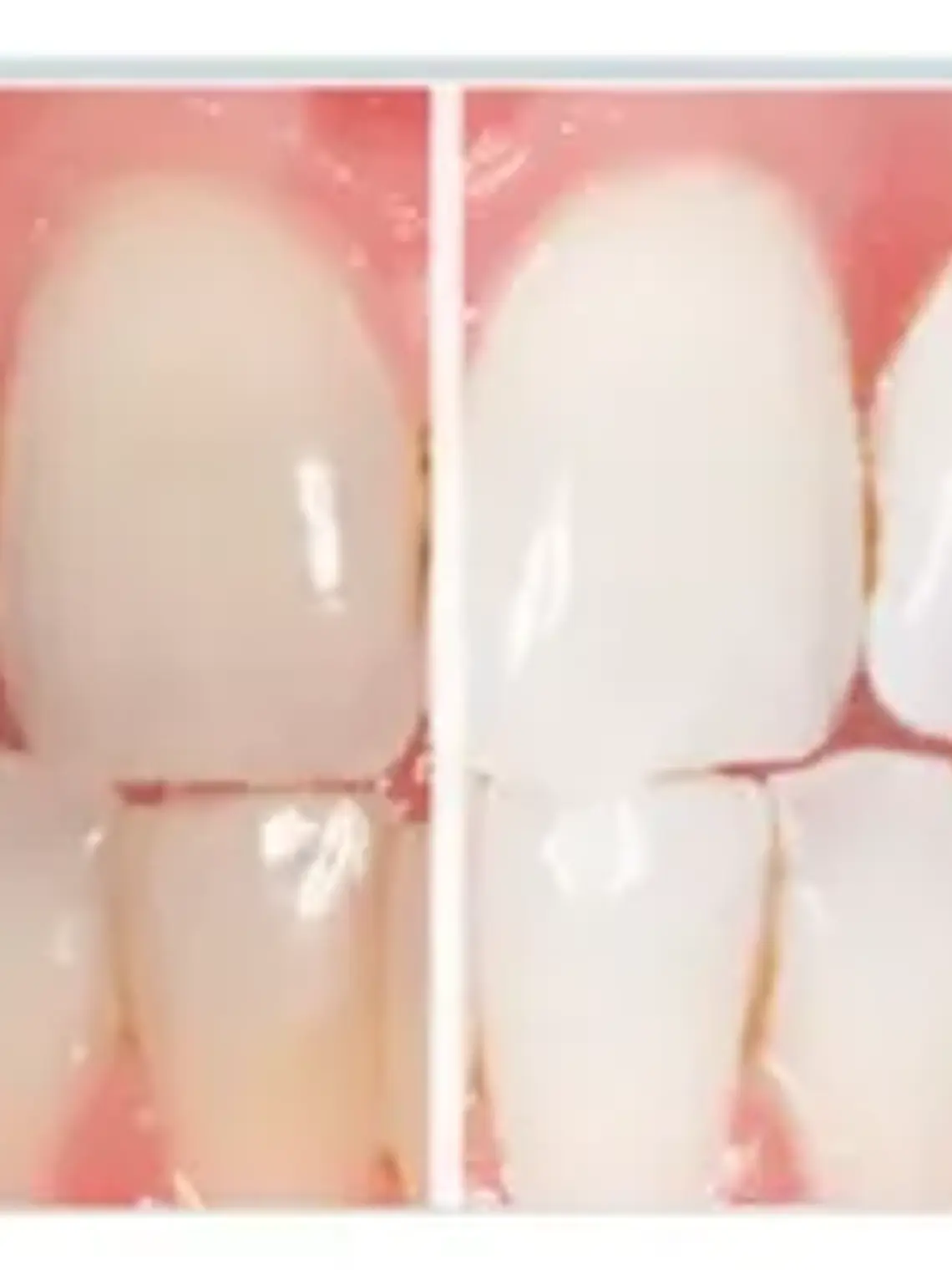 Ultradent Blanqueamiento 1 Jer 22%  X 3 Gramos 2