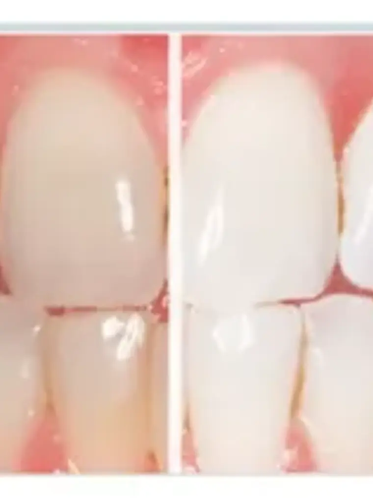 Ultradent Blanqueamiento 1 Jer 22%  X 3 Gramos 2
