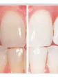 Ultradent Blanqueamiento 1 Jer 22%  X 3 Gramos - Miniatura 2