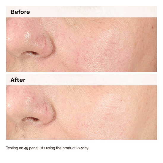 Alpha Arbutin 2% + Hyaluronic Acid for Hyperpigmentation 3