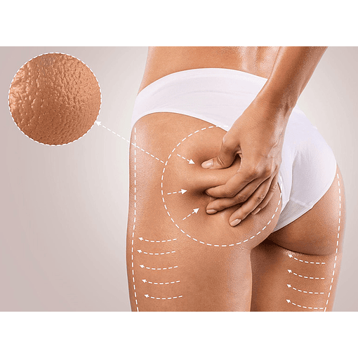 Anticelulitis Rolling 9D Pro - Pack 6 Sesiones 