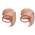 Reductivo y Reafirmante de Papada, Cuello & Escote - Pack 6 Sesiones  2