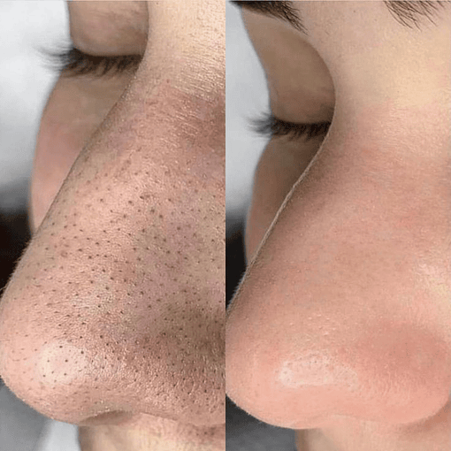 Limpieza Facial Profunda Cosmetológica