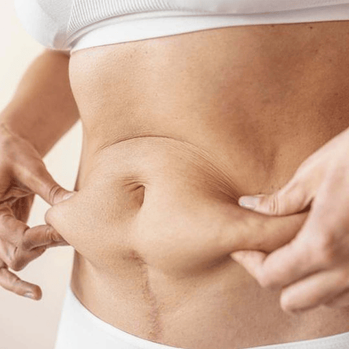 Radiofrecuencia Corporal  