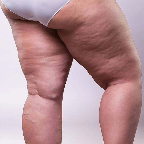 PROGRAMA LIPEDEMA INTENSIVO (20 SESIONES)