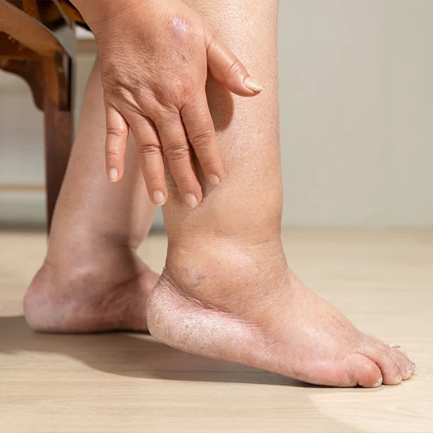 PROGRAMA LIPEDEMA PROGRESO (10 SESIONES)