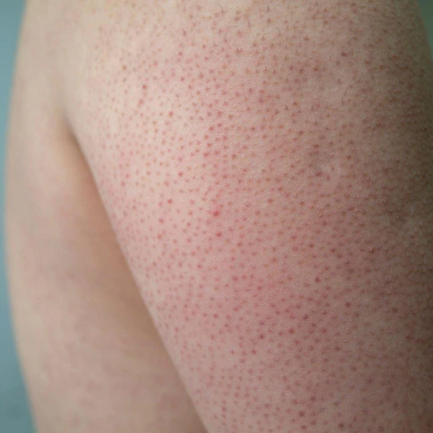 TRATAMIENTO CORPORAL PARA QUERATOSIS PILARIS
