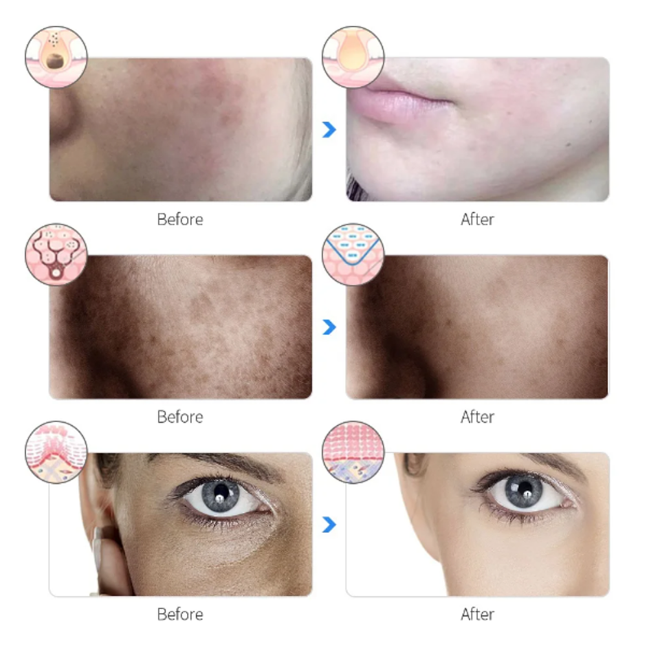 Máscara Led Facial Luz Terapia Fotón Tratamiento Facial Inalámbrica 5