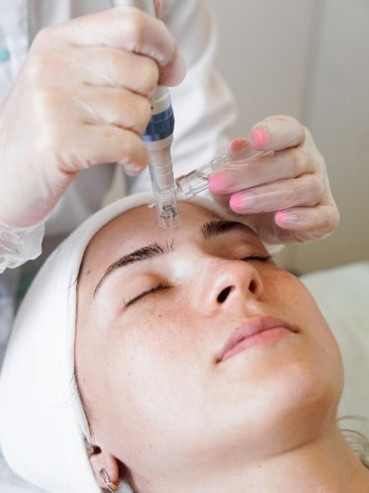 Microneedling / Dermapen 1