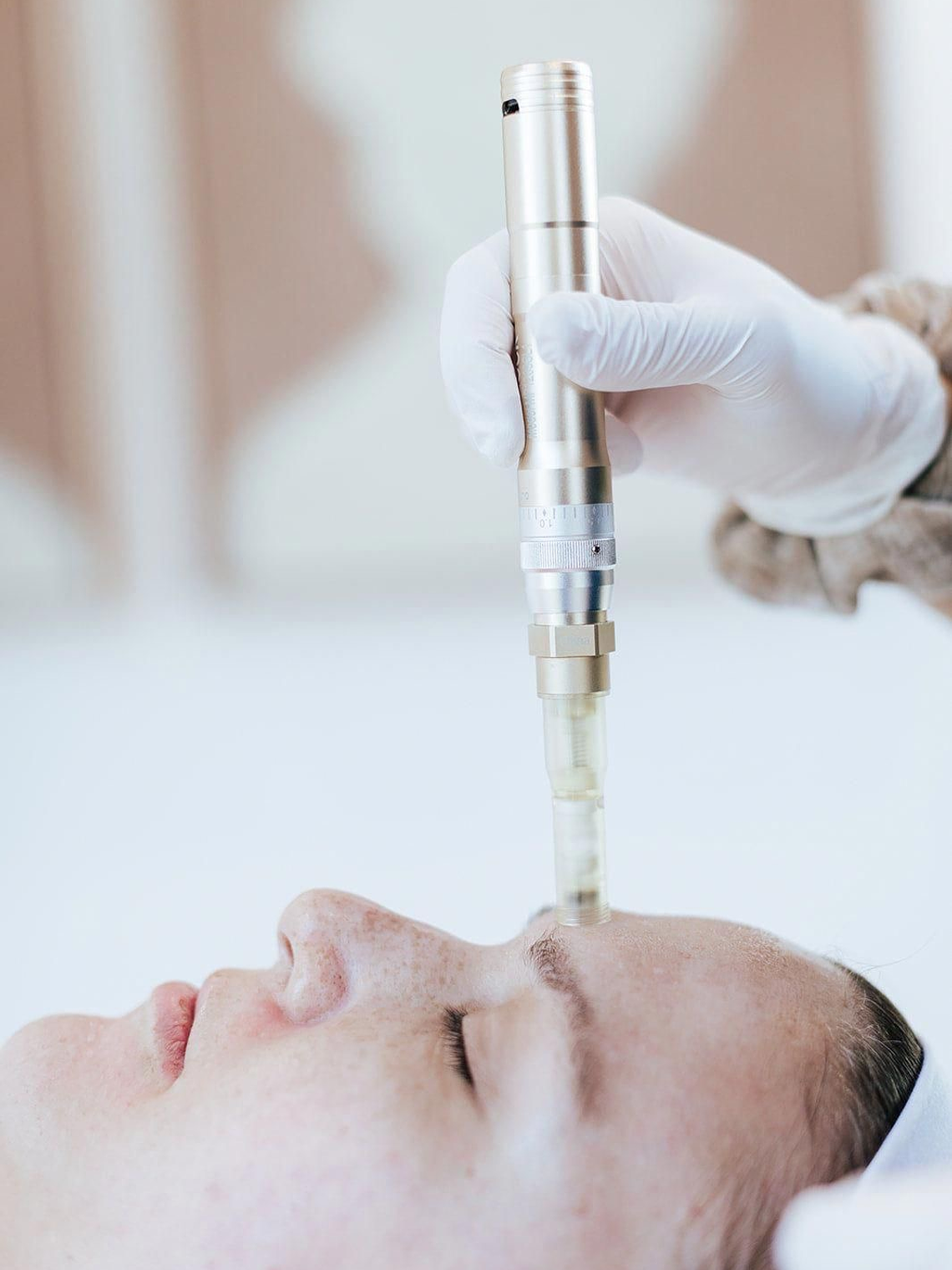 Exosomas con Microneedling 1