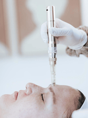 Exosomas con Microneedling
