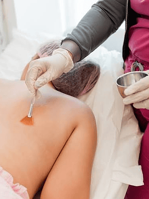  Peeling Químico Espalda